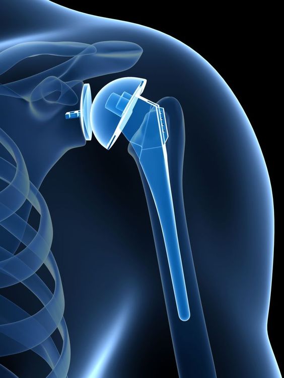 Joint Replacement Surgery: An Overview